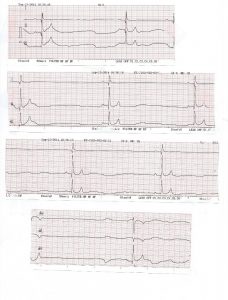 ecg max bradiarritmia o sss