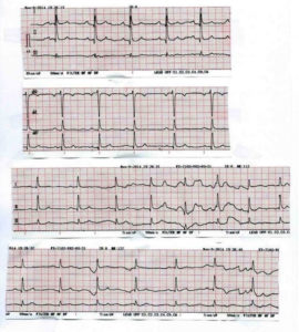 ECG con tratamiento médico