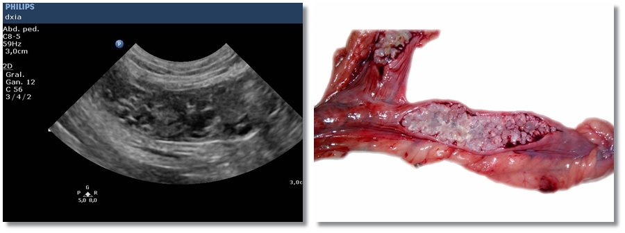 Endometritis Quística DXIA