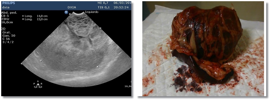 Tumor Explénico Tumor de Bazo DXIA