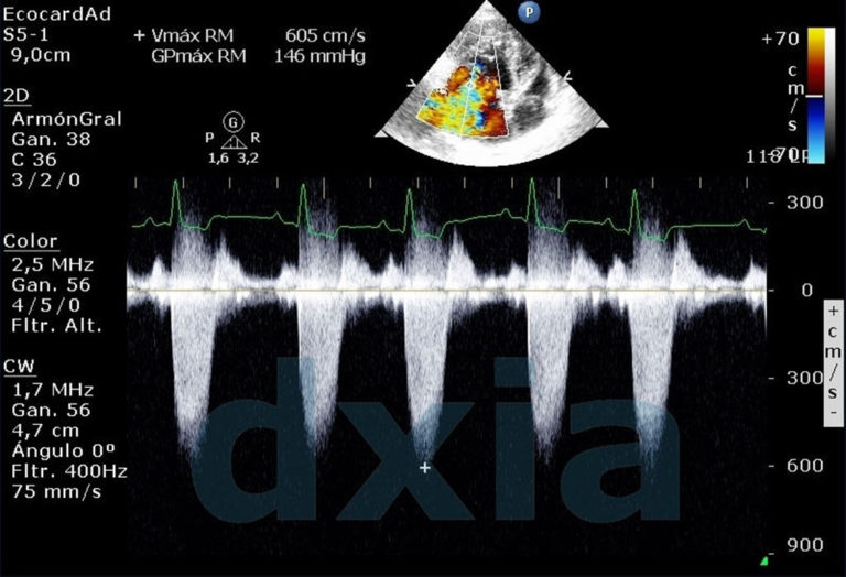 Ecocardiograma ECG DXIA