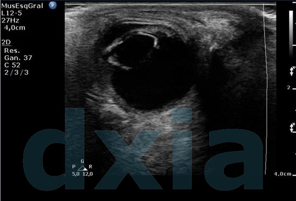ecografía ocular modo 2d DXIA