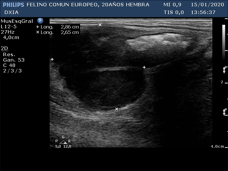 Ecografia Frangelica Asa del ID con neoformación 01