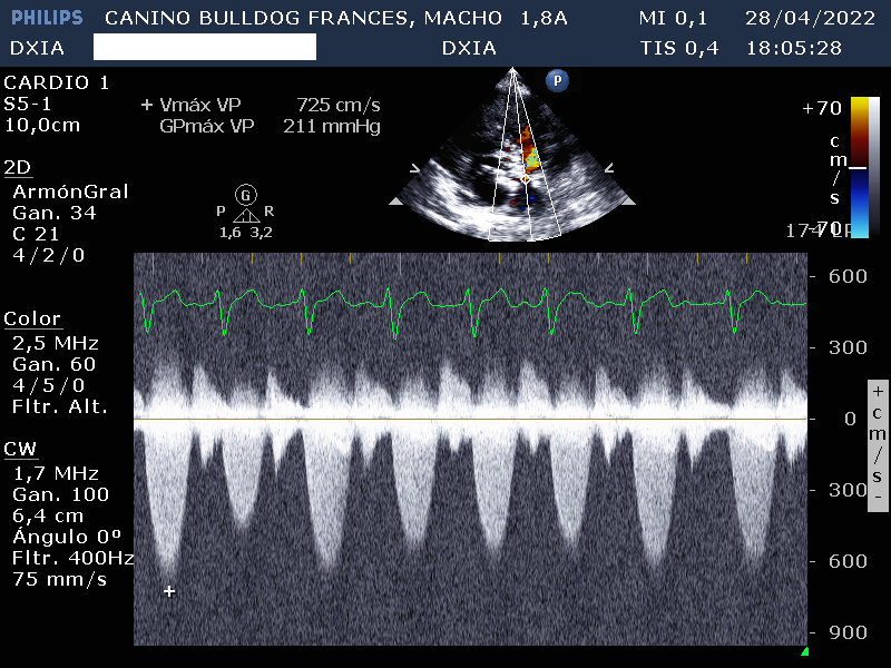 Soplo IV/Estenosis Pulmonar